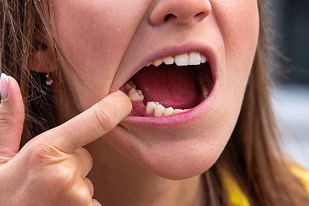 Person with a gap in their lower arch