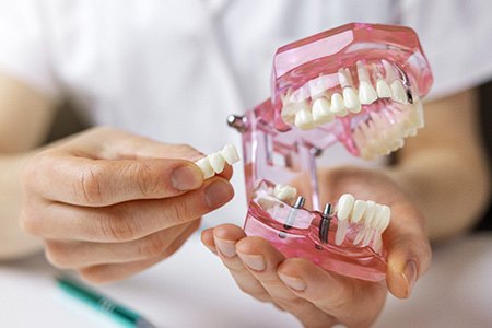 Dentist holding an implant bridge with mouth mold