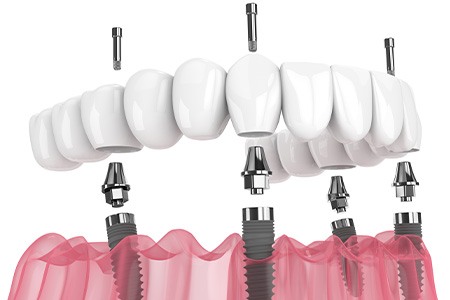 Detailed look at an implant denture