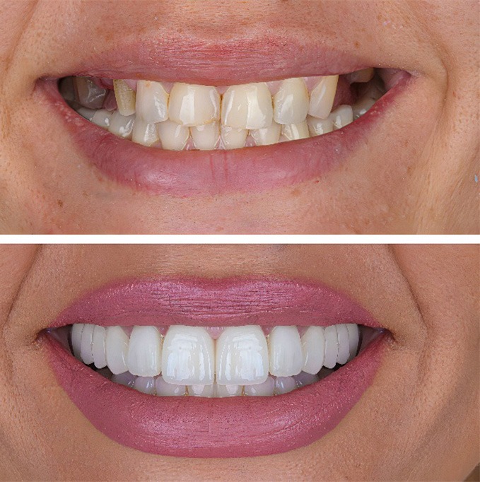 Woman going through the process of getting veneers