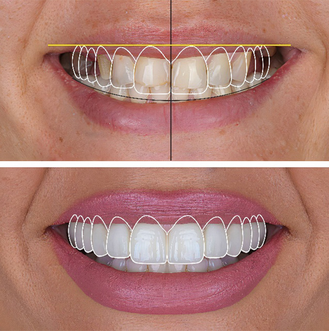 Woman going through the process of getting veneers