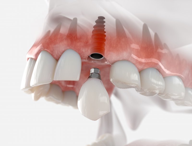 digital image of a dental implant in upper arch